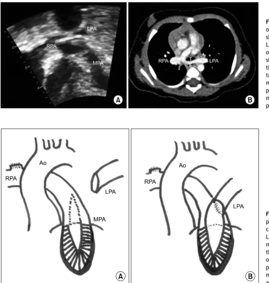 Fig. 1. (A) Subcostal coronal view  of a preoperative echocardiogram  showing the hypoplastic MPA and  LPA originating from RPA