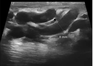 Fig. 4. Ultrasonography showed that the maximum resting diameter of the spermatic vein had decreased to 3 mm.