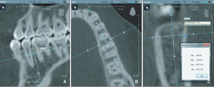 Figure 1. Cortical bone density measurement. A, The vertical reference line bisects the interdental area and is parallel to  the long axes of the roots in the sagittal slice