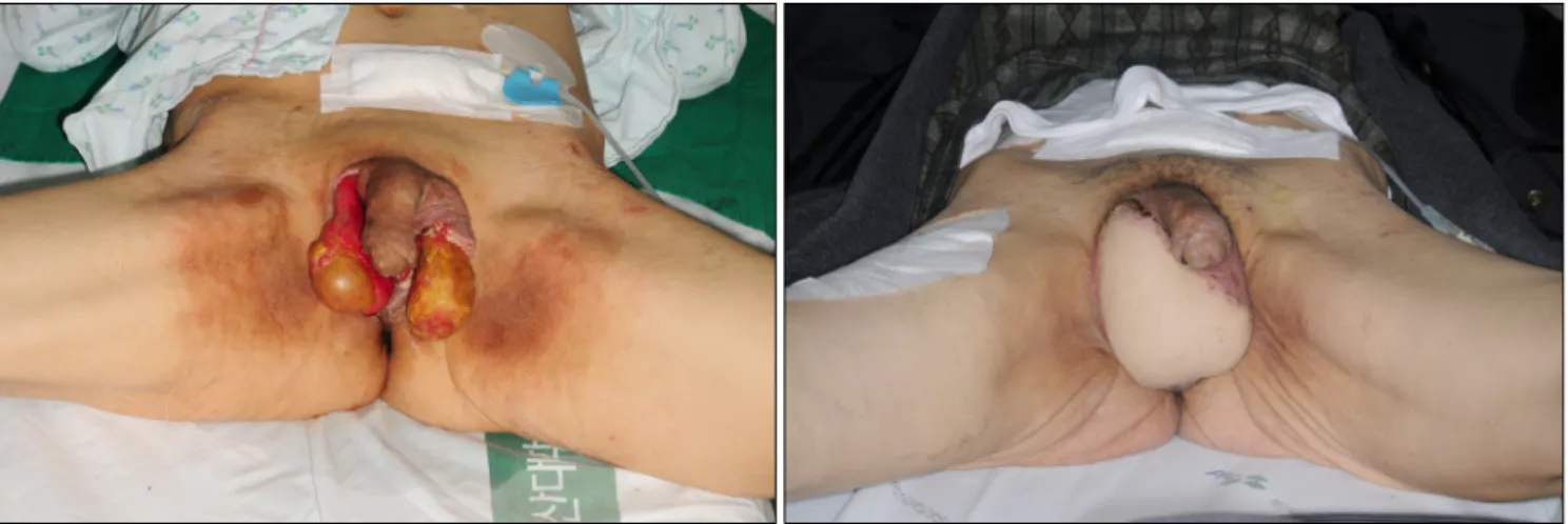 Fig. 1. Preoperative and postoperative one-month views after scrotal reconstruction by anterolateral thigh perforator (ALTp) flap that had two  perforators