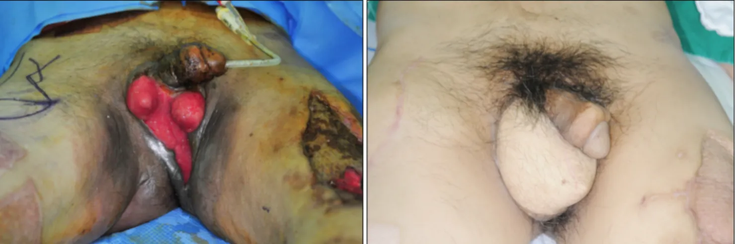 Fig. 4. Preoperative and postoperative 4-month views with anterolateral thigh perforator flap.