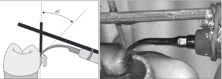 Figure 1. Ultrasonic instrumentation with the scaler-tip angulation of 45 o .
