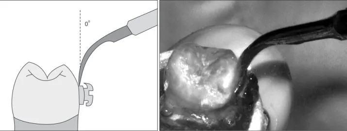 Figure 2. Ultrasonic instrumentation with the scaler-tip angulation of 0 o .