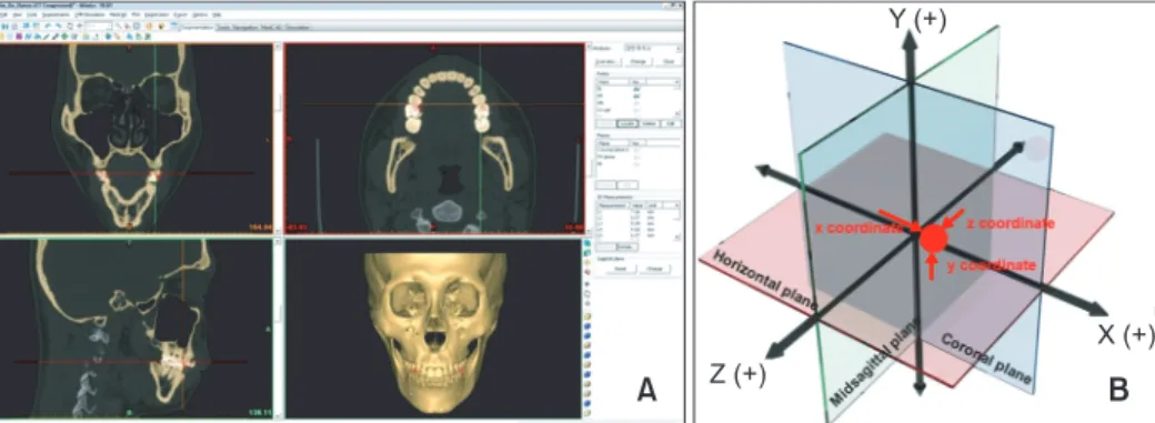 Figure 2. The three-dimensional (3D) reconstructed model. A, 3D reconstruction of computed tomographic images; B,  3D coordinate system.