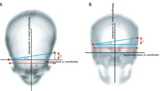 Figure 3. Measurement of the angular deviations. A, Anteroposterior deviation ( θ 1 ); B, vertical deviation (θ 2 )