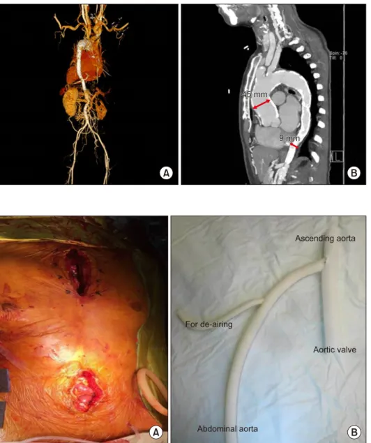 Fig. 1. Preoperative computed to- to-mography. (A) Multifocal luminal  narrowing in the descending aorta