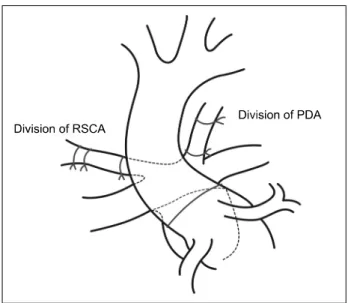 Fig. 1. Intraoperative image of the RSCA connected to the pulmo- pulmo-nary artery. RSCA, right subclavian artery; MPA, main pulmopulmo-nary  artery; Ao, aorta; PDA, patent ductus arteriosus.
