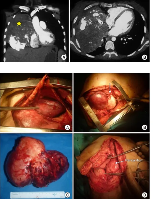 Fig. 1. Chest computed tomography  shows lage anterior medidastinal  mass with calcification and  col-lapsed right lung (star).