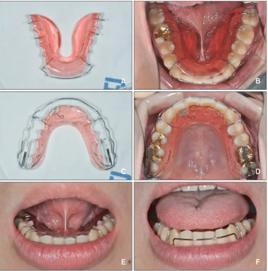 Figure 12. Re-treatment with a tongue elevator. After relapse occurred, a tongue elevator was used in the lower arch (A  and B), and a wrap-around removable retainer with occlusal rests and reduced resin plate was used in the upper arch (C  and D); Frontal