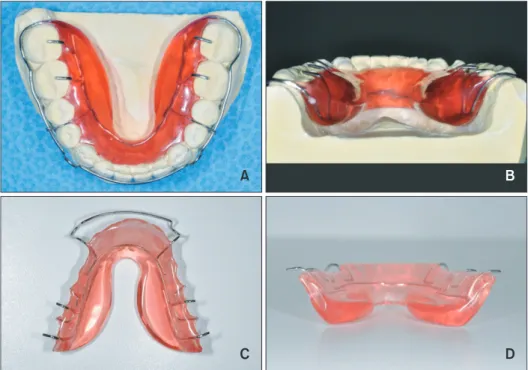 Figure 1. Design of the tongue elevator. Occlusal view (A) and lingual view (B) of a conventional tongue elevator