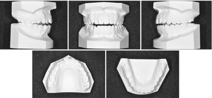 Figure 4. Pretreatment dental casts. 