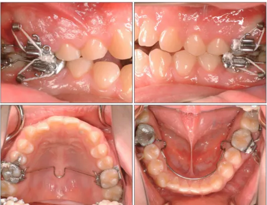 Figure 6. Initial treatment mechanics for molar intrusion. Four C-tubes installed in the each posterior area with a  transpalatal arch in the upper dentition, and a lingual arch in the lower arch