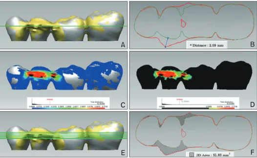 Figure 2. Quantitative assessment of artifacts on the basis of discrepancies of two models, each restoration model  and no restoration model as the control