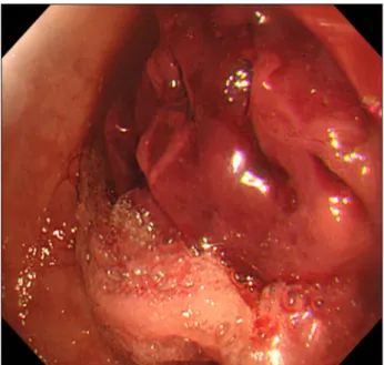 Fig. 2. An esophagographic examination showing an epiphrenic  diverticulum on the left side of the esophagus.