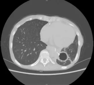 Fig. 5. An image from a mediastinal-window chest computed to- to-mography scan on postoperative day 65, showing only an  air-con-taining cavity, corresponding to a change from the lung abscess.