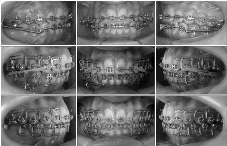 Figure 3. The mandibular protraction appliances. A, Right  side; B, left.