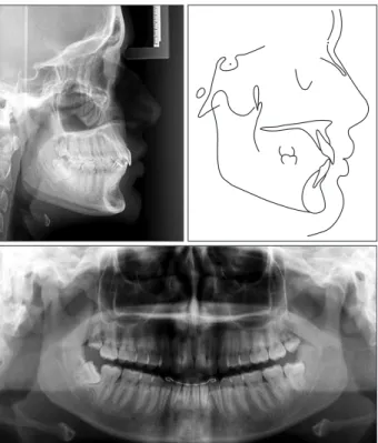 Figure 9. Superimposition of the post-treatment (solid  line) and three years follow-up (dotted line) tracings.