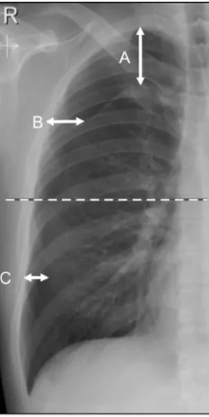 Fig. 1. Quantification of pneumothorax size on chest radiograph  using the Collins method