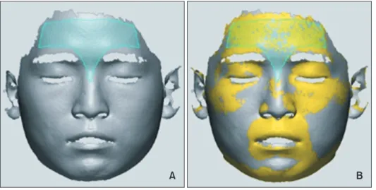 Figure 4. A, Forehead mesh  region; B, best-fit alignment  with forehead mesh region.