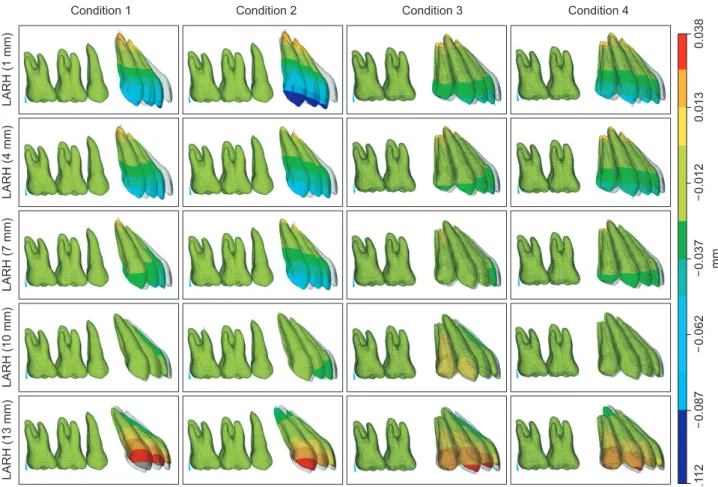 Figure 8. Comparison of the sagittal effects (Y-axis) of the different heights and positions of the low lingual anterior  retraction hooks (LARHs) in the three dimensional finite element model