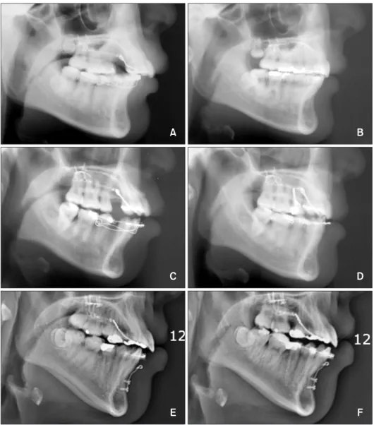 Figure 3. Pre- and post-lateral cephalograms. A and B, Low lingual anterior retraction hook (LARH) - the patient needed  controlled lingual tipping; hence, a LARH vertical height of 4 mm was used