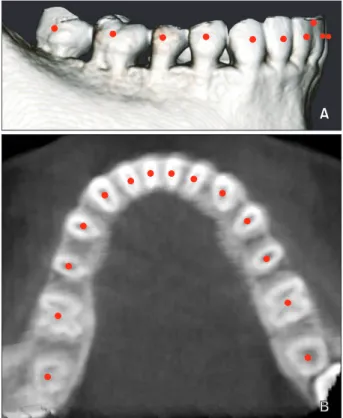 Figure 1. Digitized rendered view of a cone-beam com- com-puted tomography scan.  A, Facial axis points