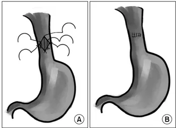 Fig. 2. Surgical procedure of our approach. (A) The anterior wall  of the esophagus was cut longitudinally and the posterior wall  was preserved intact