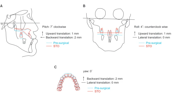 Figure 5. Surgery planning. 0-degree of yaw, 7-degree of pitch, 4-degree of roll, 0 mm of lateral translation, 2 mm of  backward translation and 1 mm of upward translation of maxilla were planned