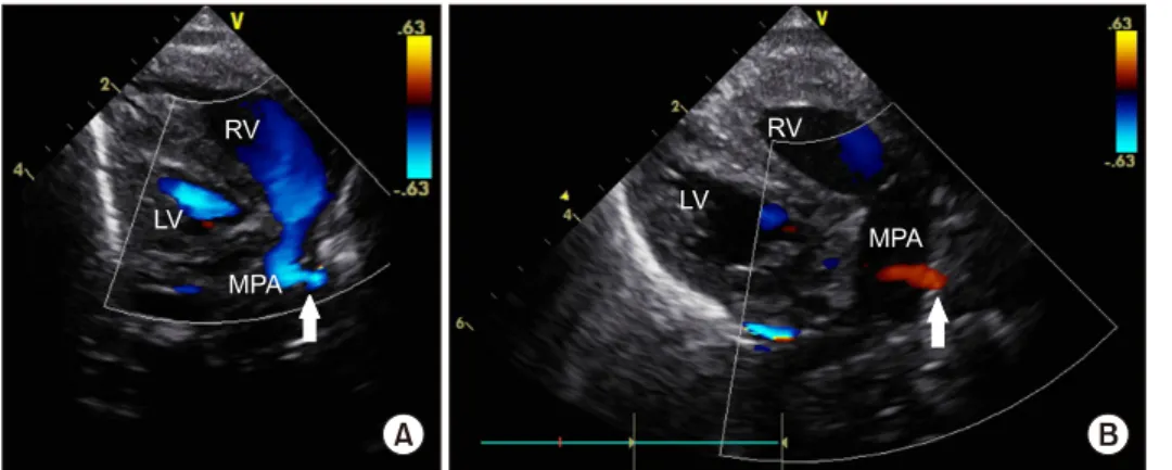 Fig. 3. (A) Right-to-left shunting  through the MPA-to-innominate  ar-tery shunt (arrow)