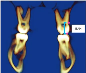 Figure  1.  Buccal  cortical  bone  thickness  (BCBT)  and  palatal cortical bone thickness (PCBT) at the level of the  trifurcation of the first molar.