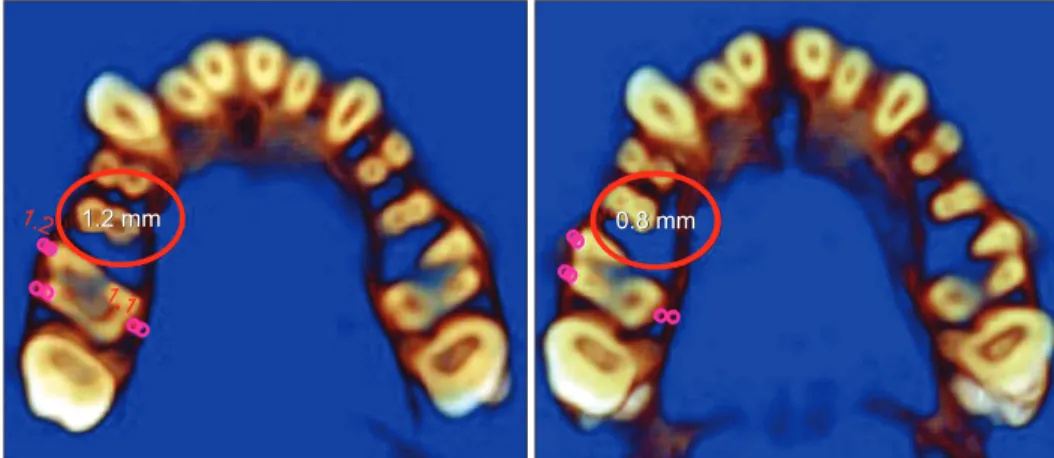 Figure 5. An example of a decrease in the buccal cortical bone thickness of the maxillary right molar.