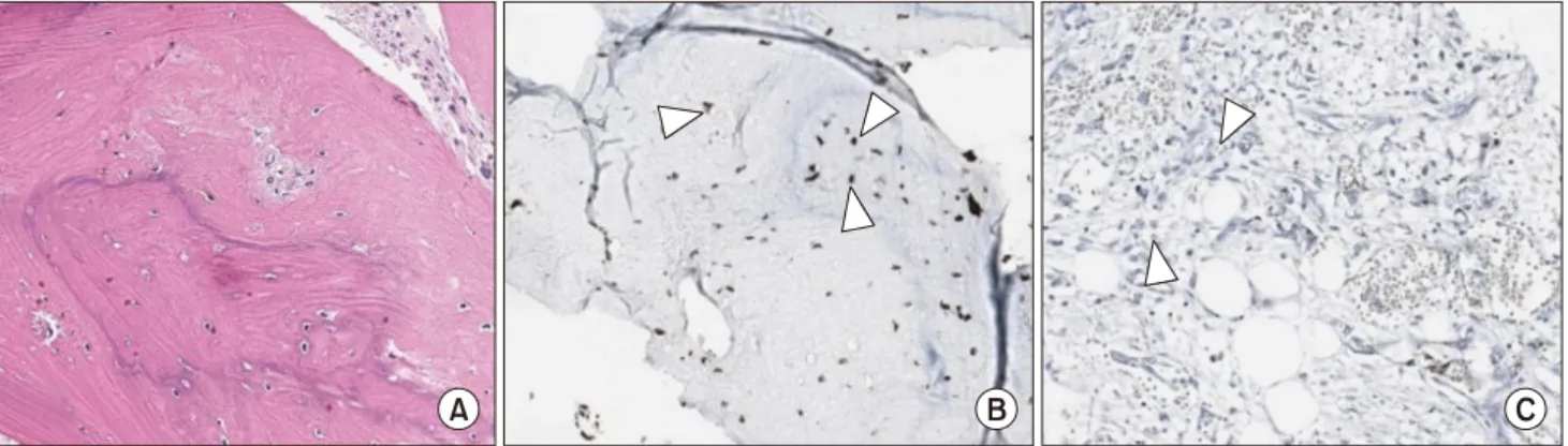 Fig. 3. Microscopic findings of the mass. (A) Osteoid formation, a definitive characteristic of osteosarcoma (H&amp;E staining, ×20 magnifica- magnifica-tion)