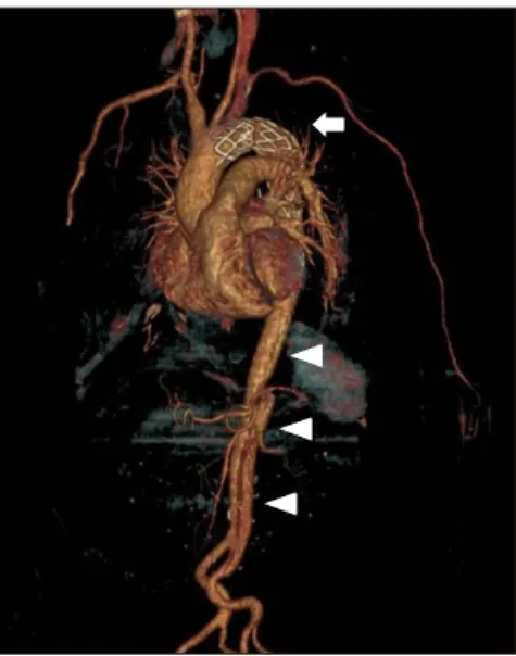 Fig. 2. Three-dimensional computed tomography of the aorta  shows successful zone II thoracic endovascular aortic repair  with-out endoleak (white arrow) and with remaining, but stable,  dis-section of the descending thoracic and abdominal aorta (white  ar