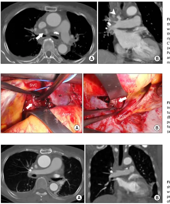 Fig. 1. (A) Initial CT scans showing  the formation of a blind pouch that  was suspicious for a PA rupture at  the distal superior aspect of the  right PA (white arrow)