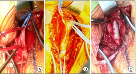 Fig. 3. Operative field view of car- car-otid endarterectomy. (A) Usage of  shunt. (B) Direct closure