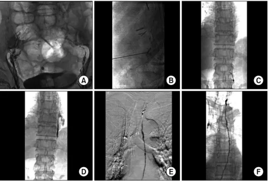 Fig. 1. Thoracic duct embolization. 