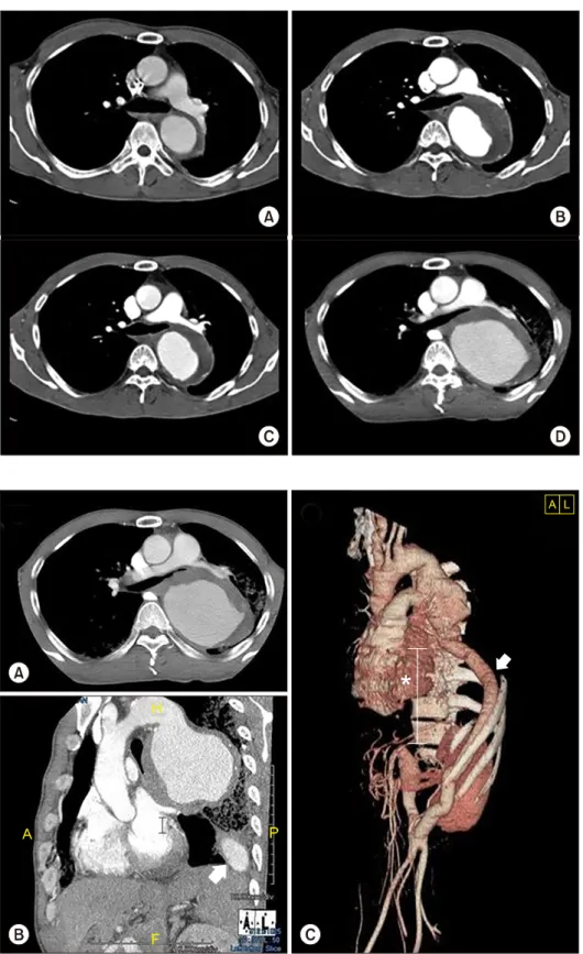 Fig. 1. Follow-up computed tomo- tomo-graphic scan 2 years after the  sec-ond operation showed a newly  de-veloped aortic aneurysm, the size  of which increased every year