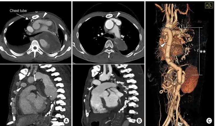 Fig. 3. Follow-up computed tomographic scan with 3-dimensional reconstruction imaging after the third operation