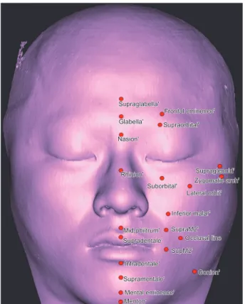 Table 6. Reproducibility of the soft-tissue measurements Localization Mean Standard  deviation p-value Midline Supraglabella distance 0.26 0.14 0.25 Glabella distance 0.35 0.12 0.08 Nasion distance 0.06 0.19 0.06 Rhinion distance −0.03 0.16 0.22 Mid-philtr