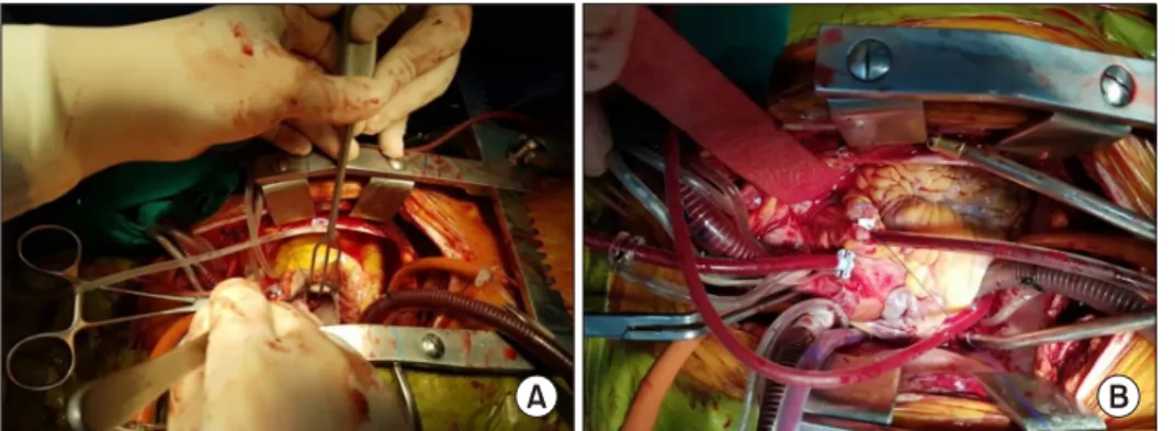 Fig. 3. Vegetation was visible on  the P1 area of the mitral valve (A). 