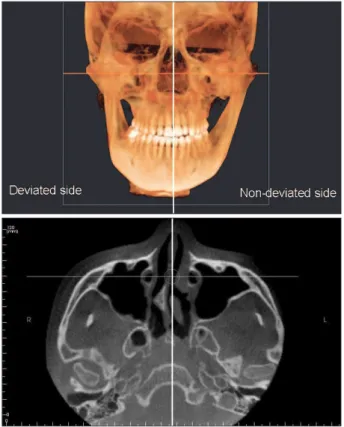 Figure 4. Cone-beam computed tomography image of  a sample case showing the largest axial condylar angle  difference between the deviated and non-deviated sides