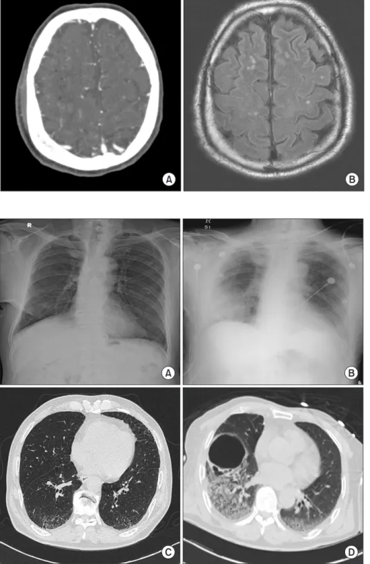 Fig. 1. (A) A computed tomography  scan of the brain showed  multifo-cal air density in the deep cerebral  white matter, suggesting cerebral  air embolism