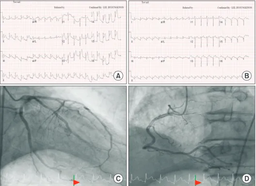 Fig. 3. (A) The initial electrocardi- electrocardi-ogram. (B) A 3-hour follow-up  elec-trocardiogram