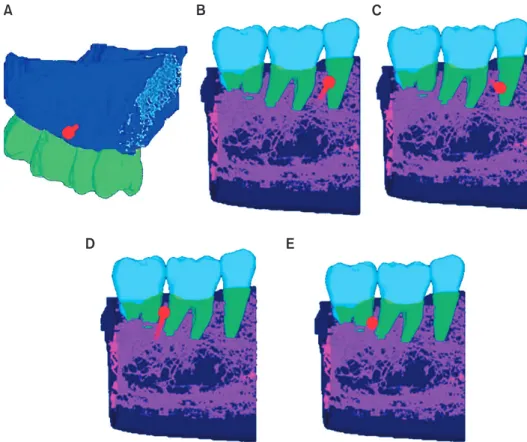 Figure 1. The five finite element models. A, Orthodontic mini-implant (OMI) placed between the maxillary second  premolar and first molar at 45°; B, OMI placed between the mandibular second premolar and first molar at 45°; C, OMI  placed between the mandib