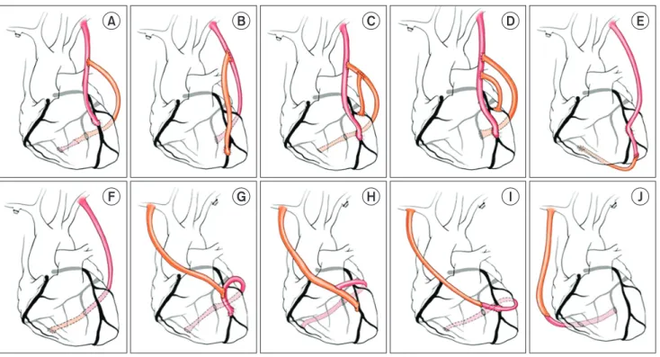 Fig. 1. Methods of modifications. Group 1: modification of a typical Y graft (n=90, 56.3%)