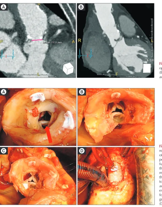 Fig. 1. Preoperative (A) and post- post-operative computed tomography  (B) showed the relief of supravalvar  aortic stenosis.