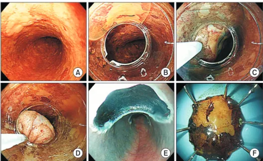 Fig. 1. Endoscopic mucosal resec- resec-tion of superficial esophageal  can-cer. (A) A 1-cm sized flat elevated  lesion on the mid-thoracic  esoph-agus