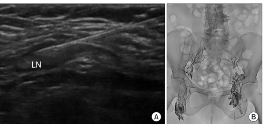 Fig. 1. Lipiodol lymphangiography. 