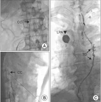 Fig. 2. TD access and embolization. (A, B) Puncture of the CC, an- an-teroposterior and lateral views