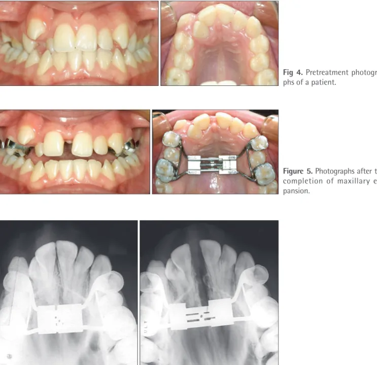 Figure 5. Photographs after the  completion  of  maxillary   ex-pansion.